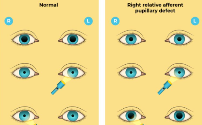 Relative Afferent Pupillary Defect (RAPD) 