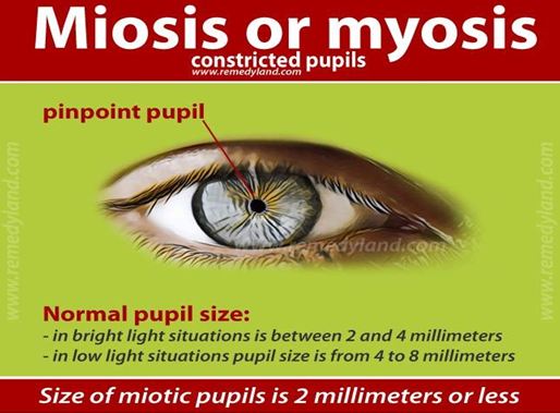 Pupillary Light Reflex Abnormality 